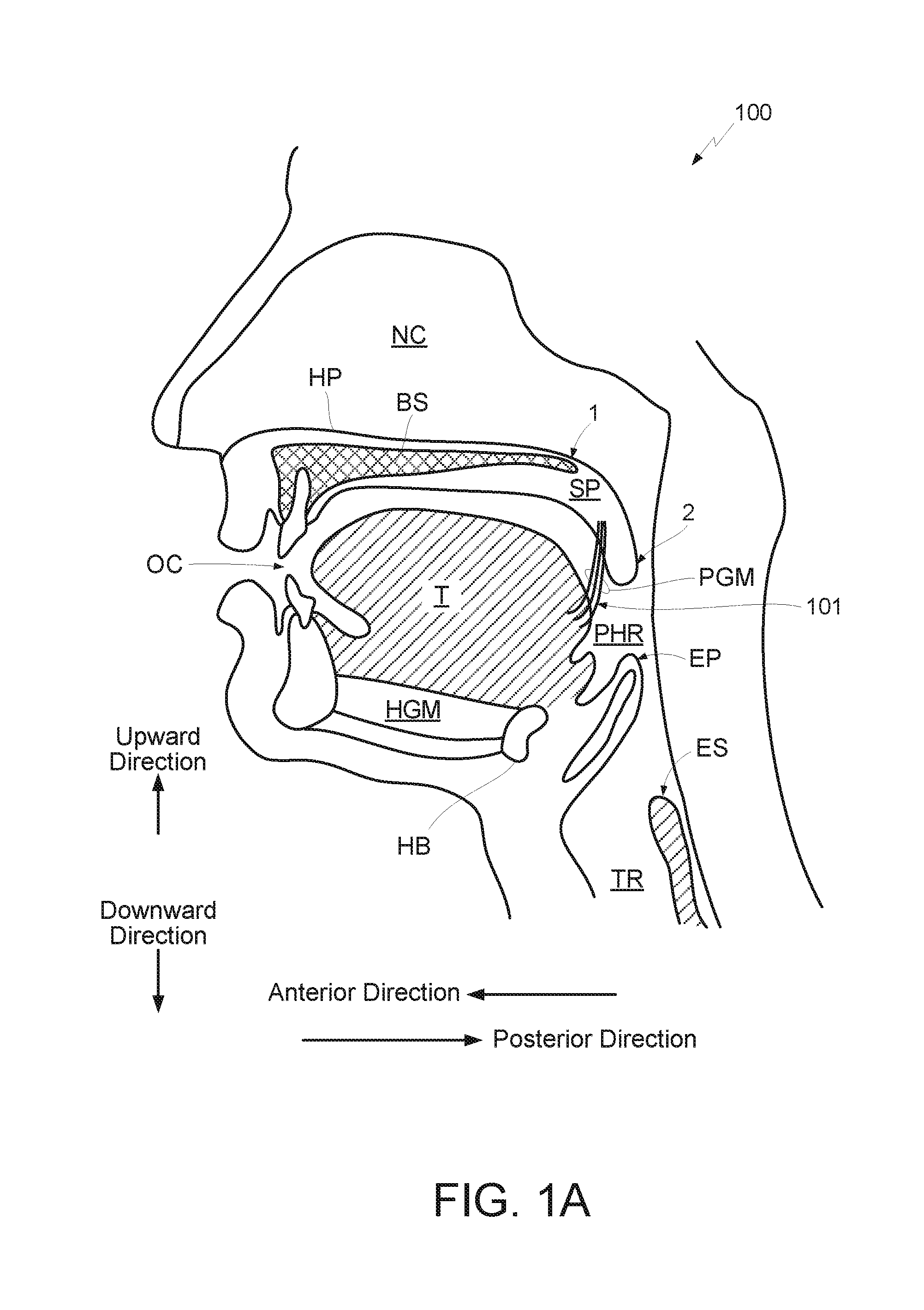 Method and apparatus for treating sleep apnea