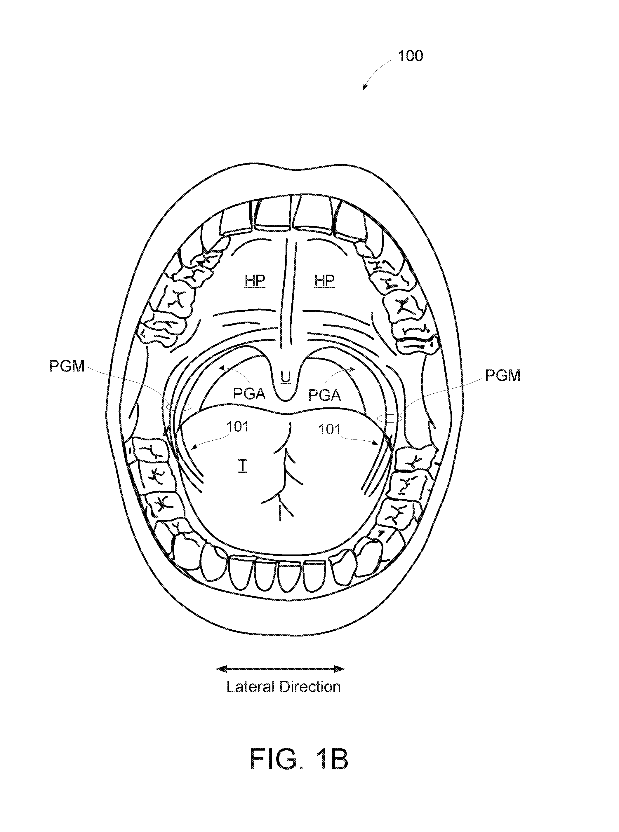 Method and apparatus for treating sleep apnea