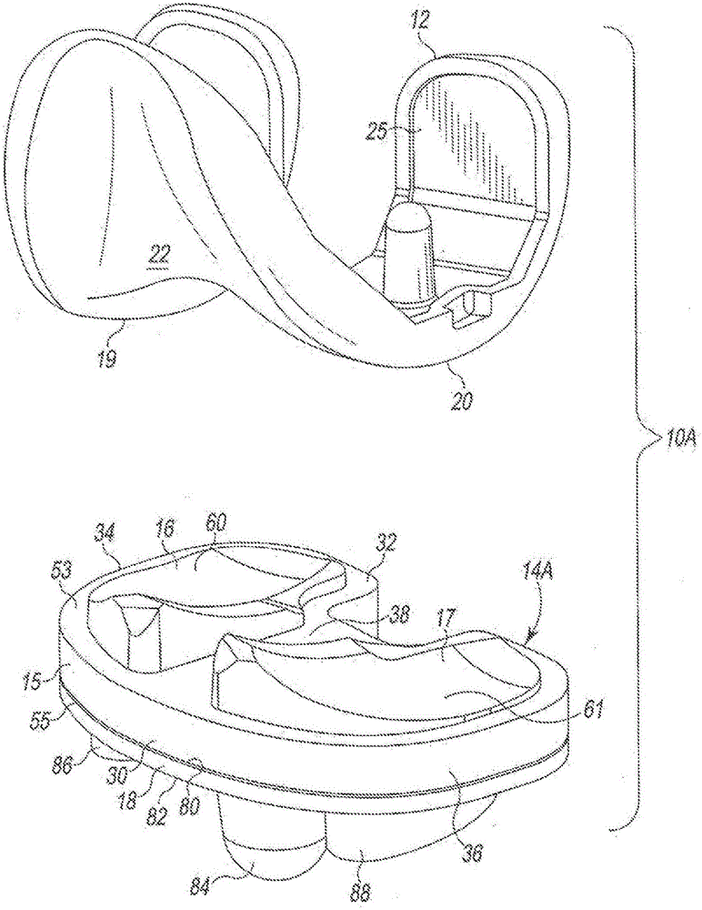 Low profile mobile/fixed prosthetic knee systems