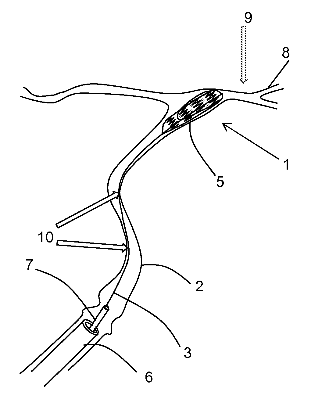 Clot removal device