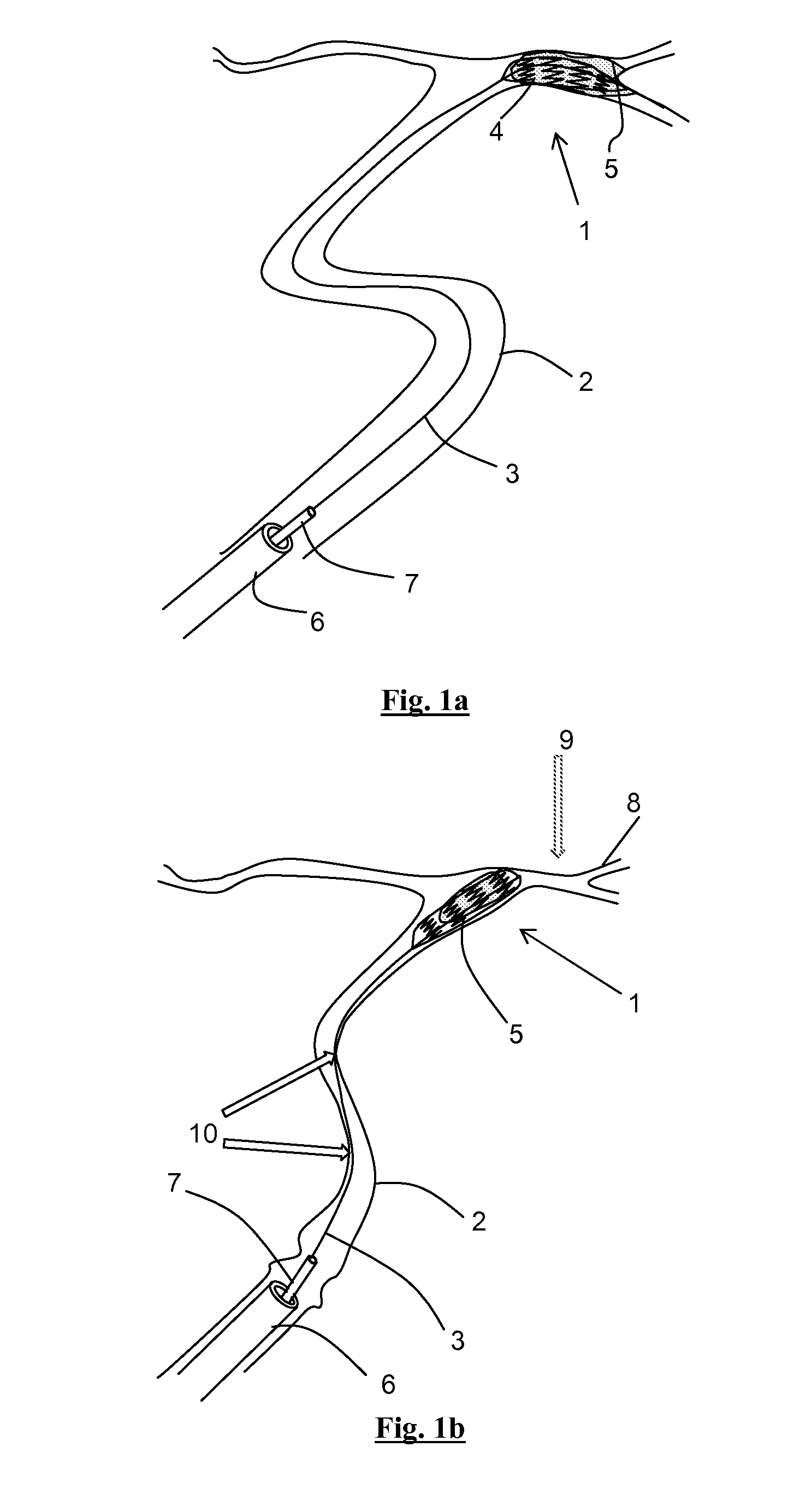 Clot removal device