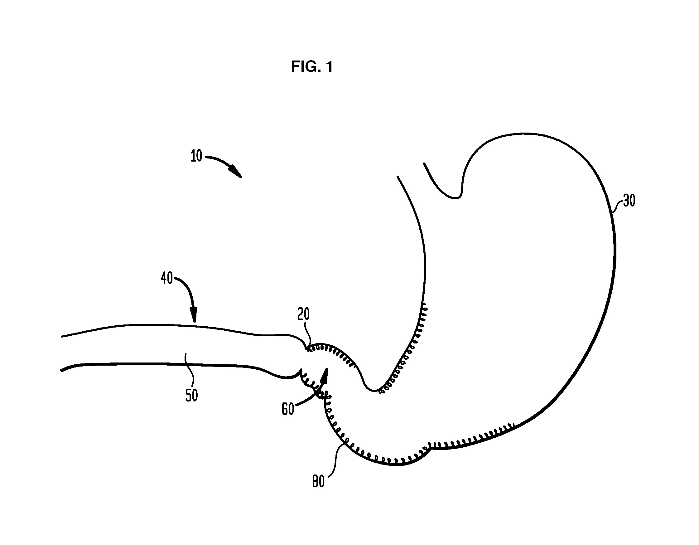 Systems and methods for treatment of obesity and type 2 diabetes