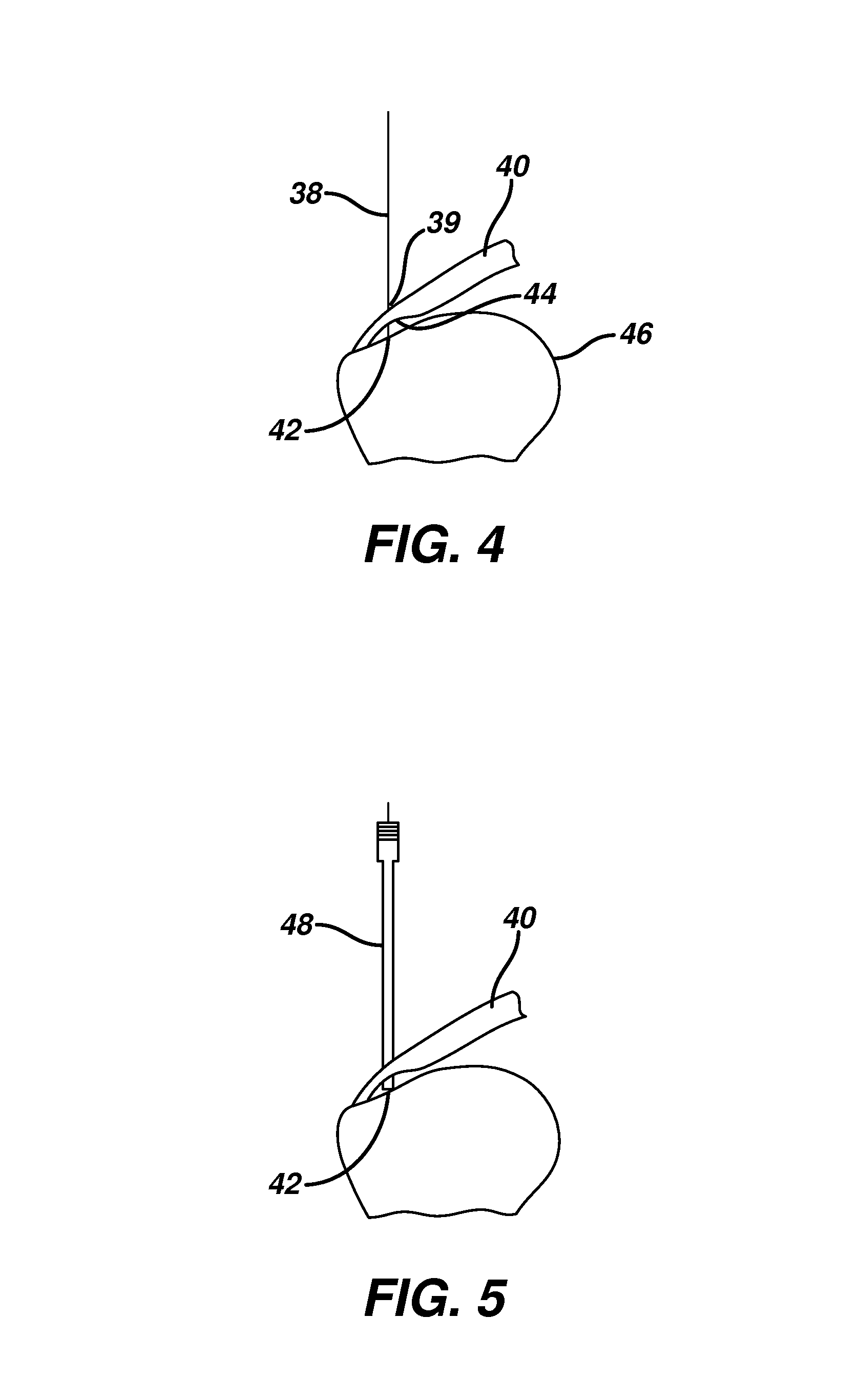 Partial thickness rotator cuff repair system and method