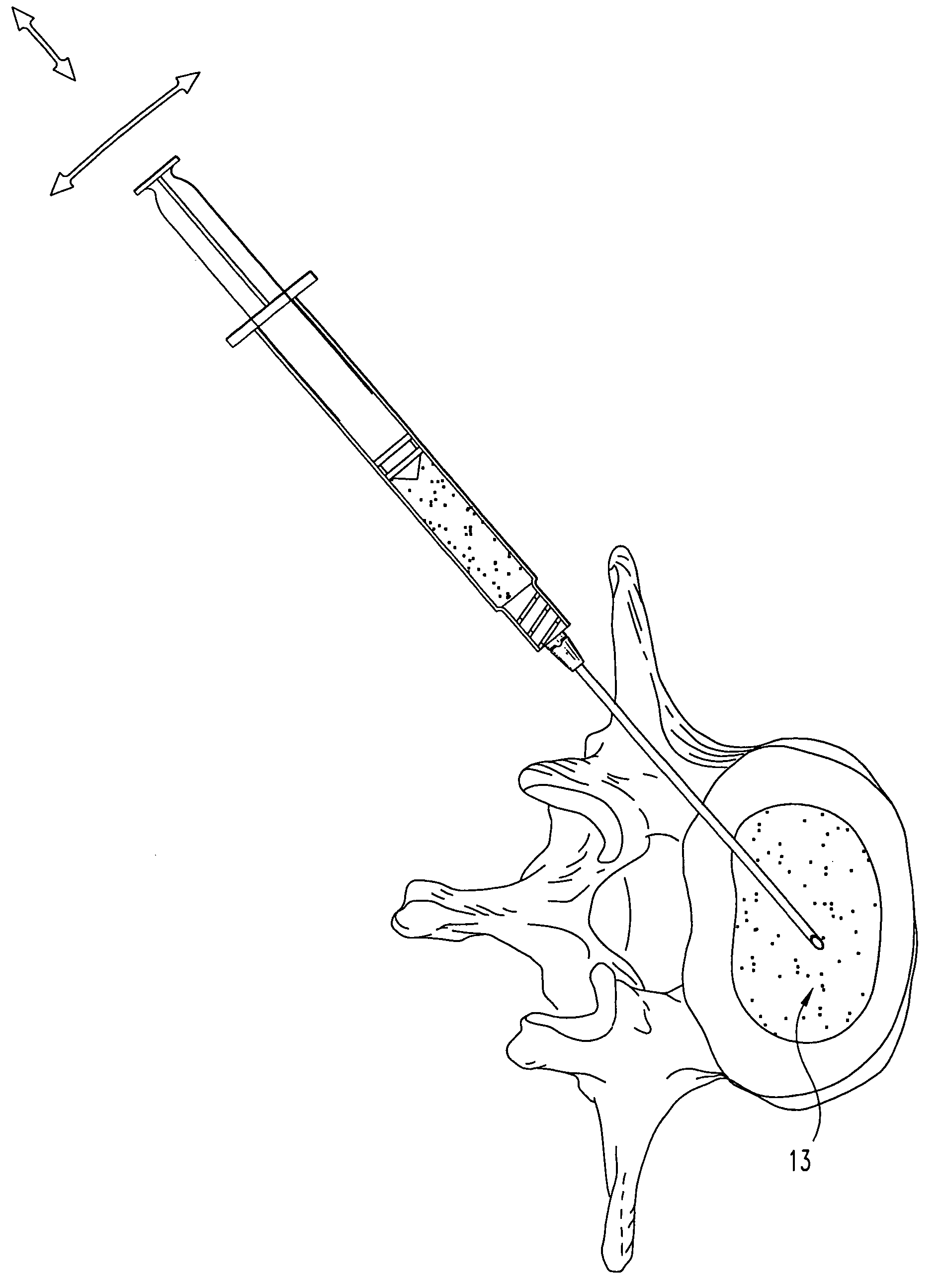 Collagen-based materials and methods for augmenting intervertebral discs