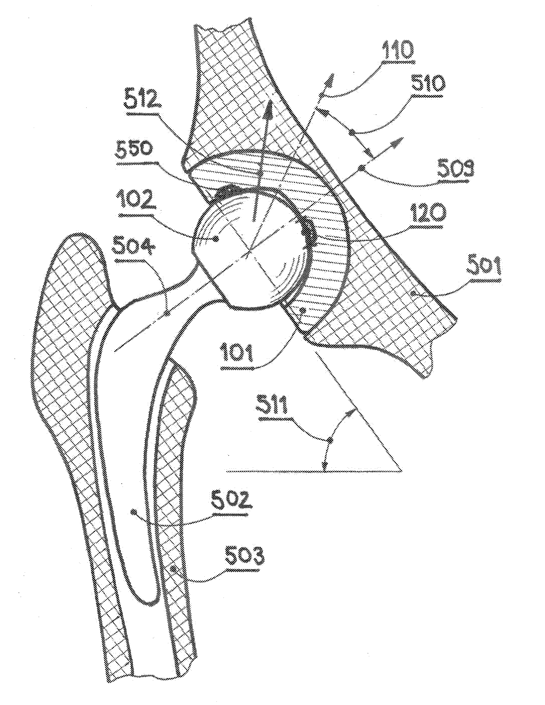 Wear-Reducing Ring for Articulations in Total Joint Replacements