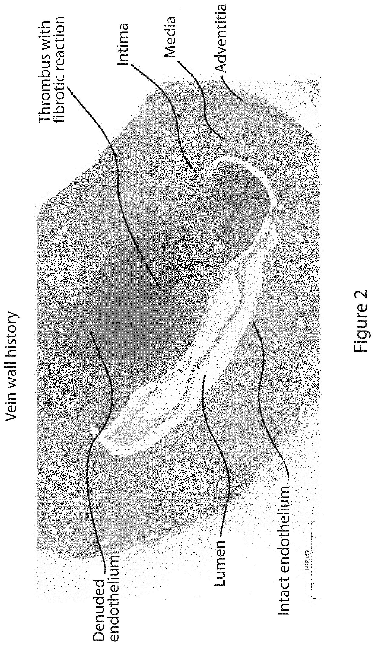 Device for denuding a body lumen