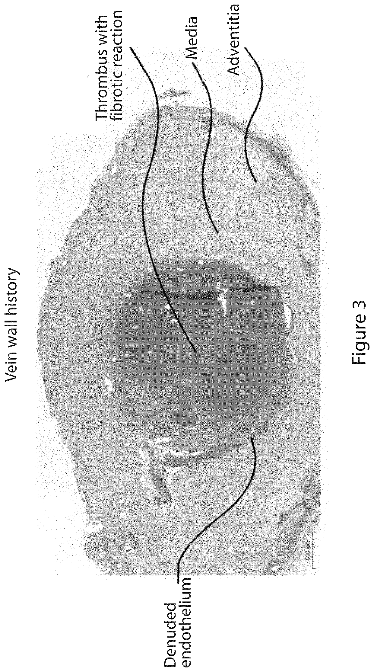 Device for denuding a body lumen