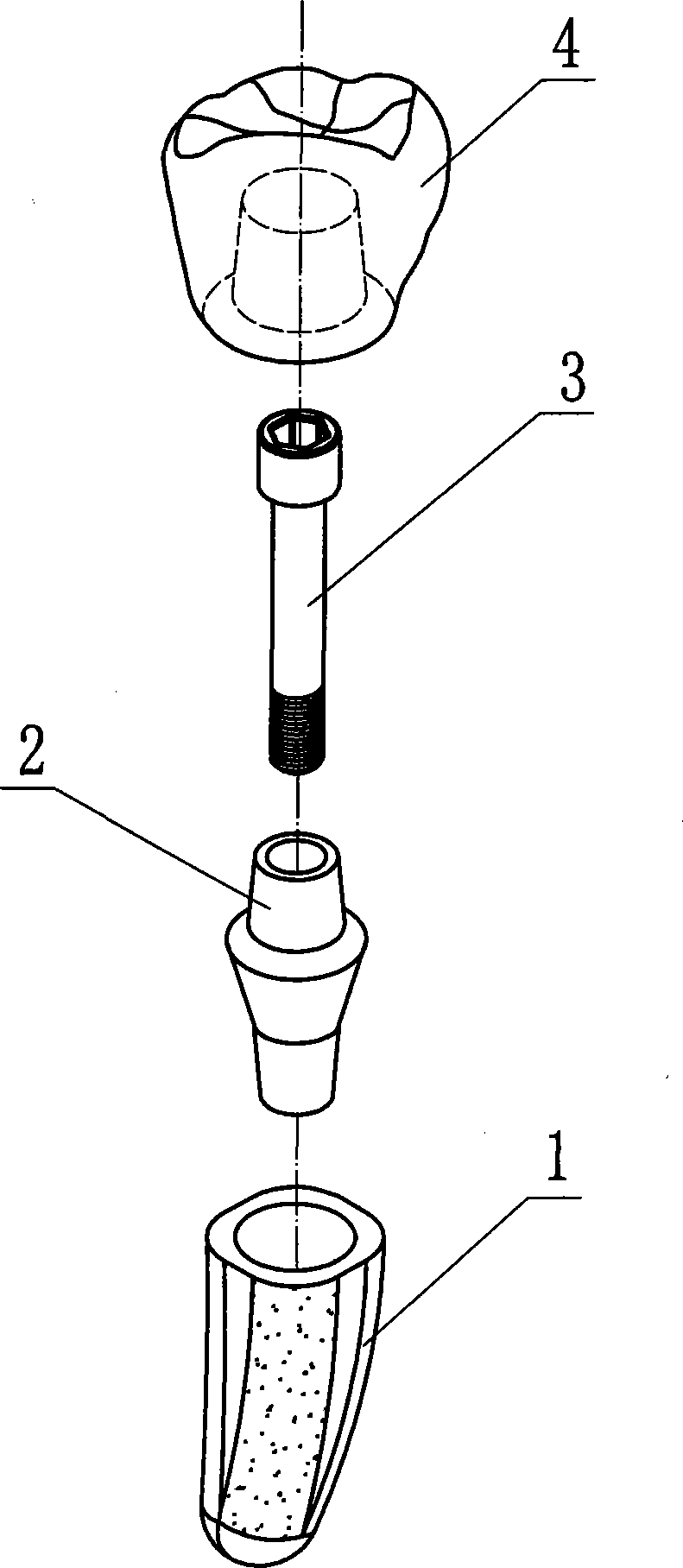 Asymmetric dental implant