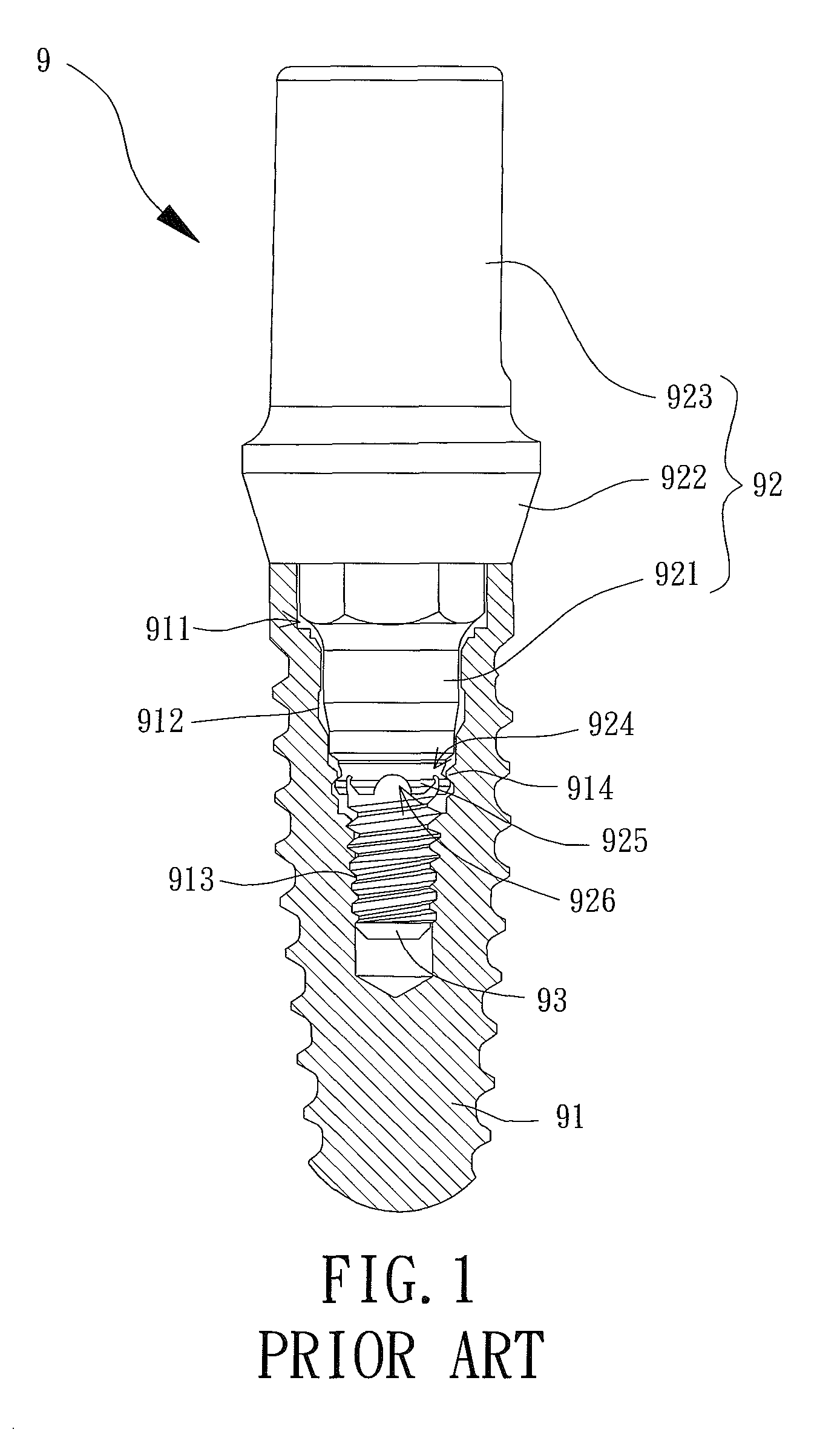 Bone implant