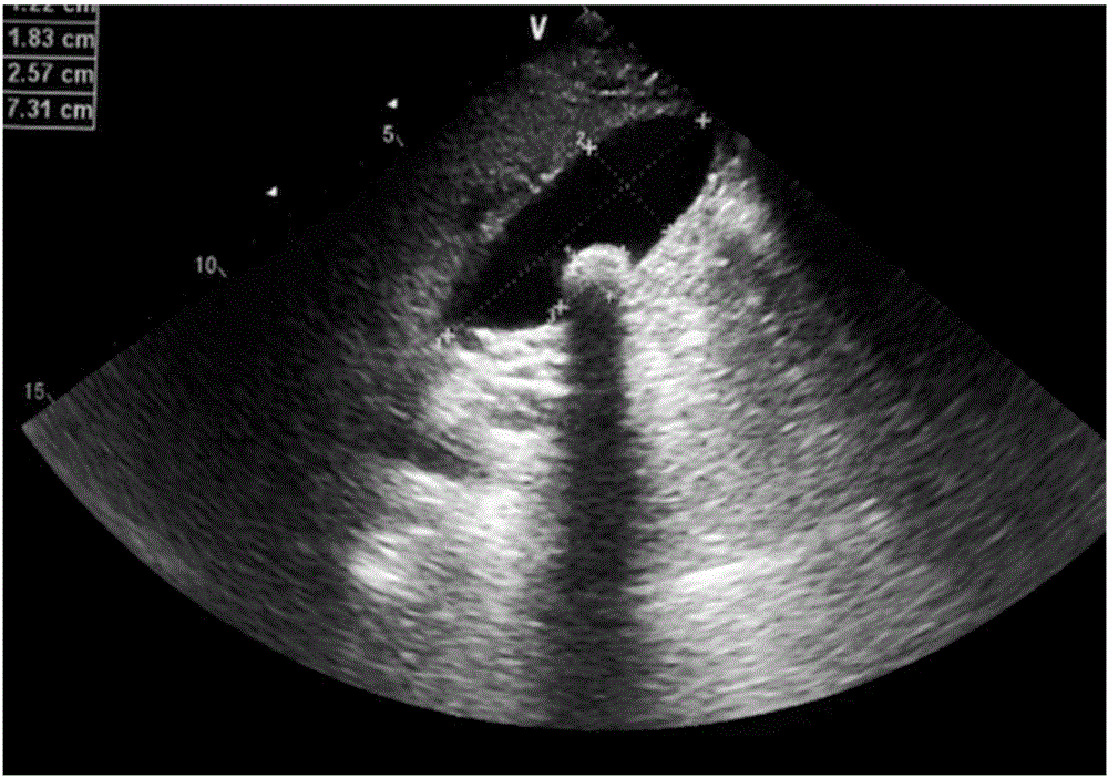 Cholelithiasis related blood plasma metabolism micro-molecular marker and application thereof