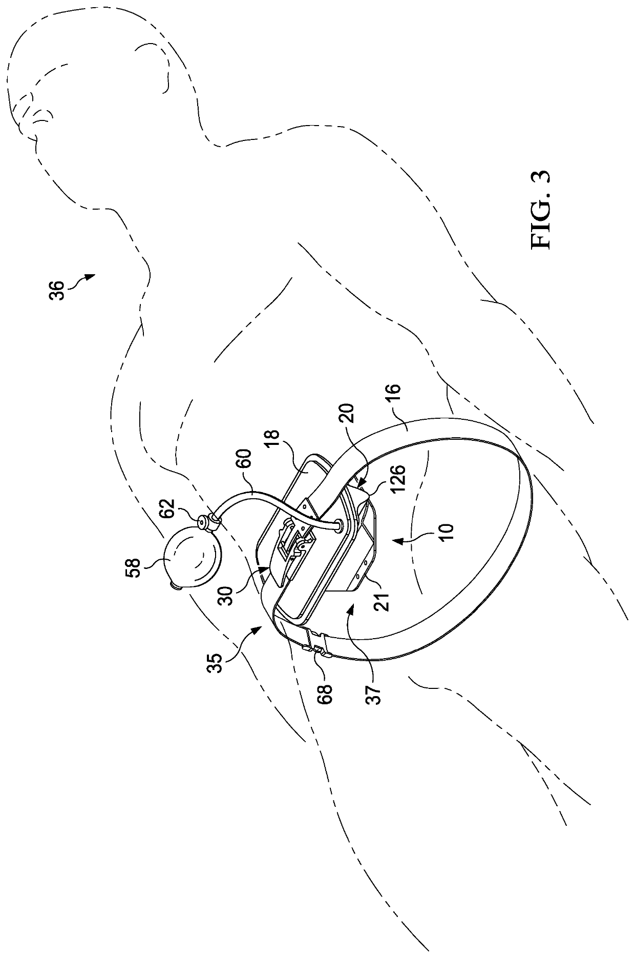 Device to increase intra-pelvic compartment pressure for the controling of internal hemorrhage