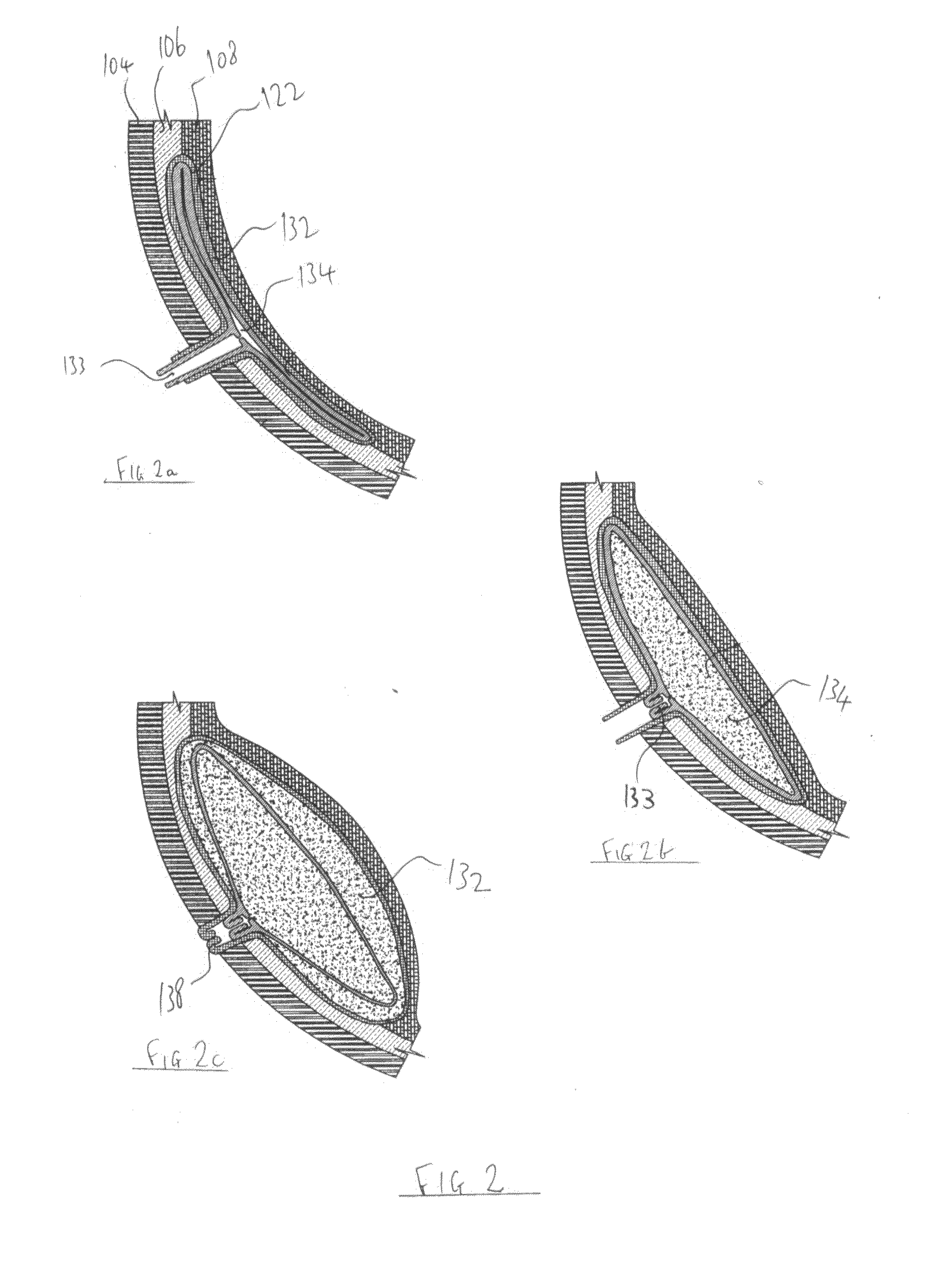 Method and device for a breast implant