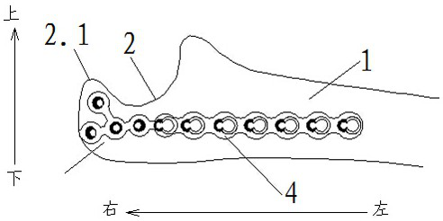 Ulna olecranon morphological anatomy locking method and steel plate structure