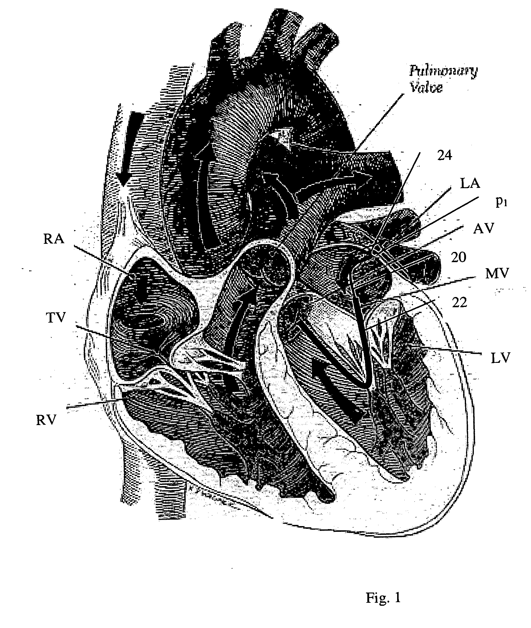 Navigation of remotely actuable medical device using control variable and length