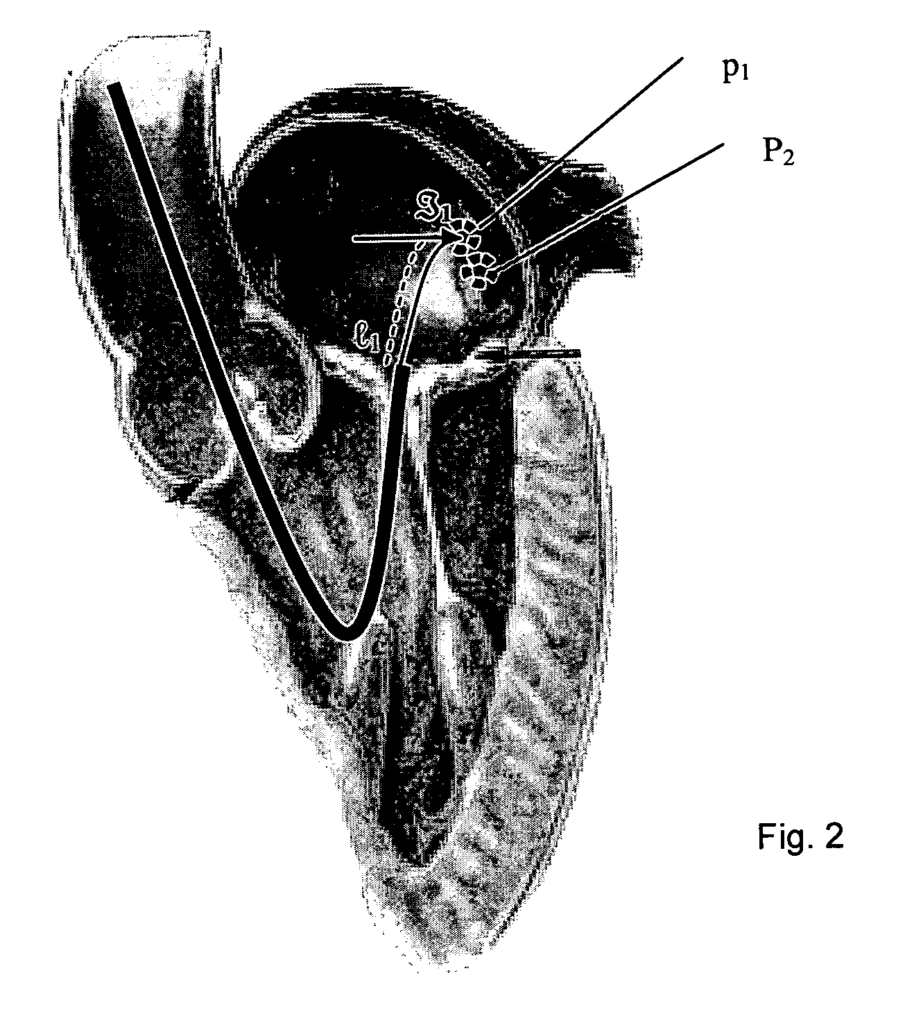 Navigation of remotely actuable medical device using control variable and length