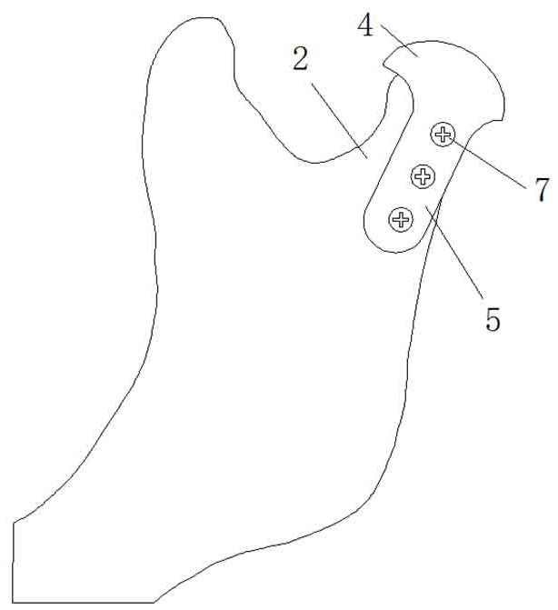 Temporomandibular joint separation cap and fixing method thereof