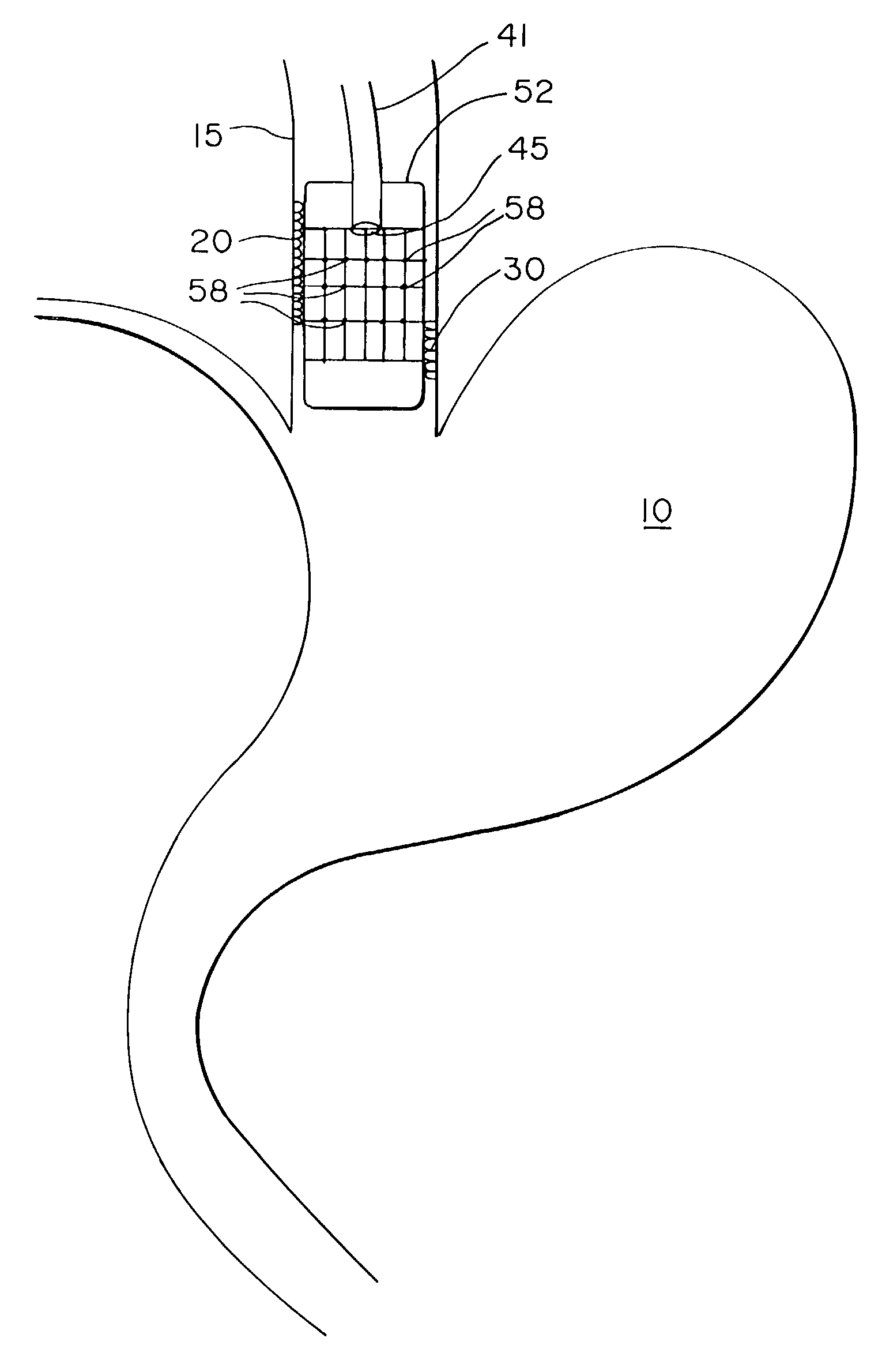 Method of treating abnormal tissue in the human esophagus