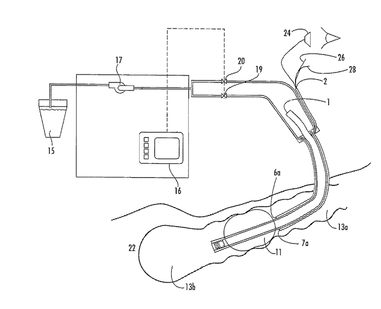 Non-invasive method of diagnosing dysphagia in patients having a tracheostomy