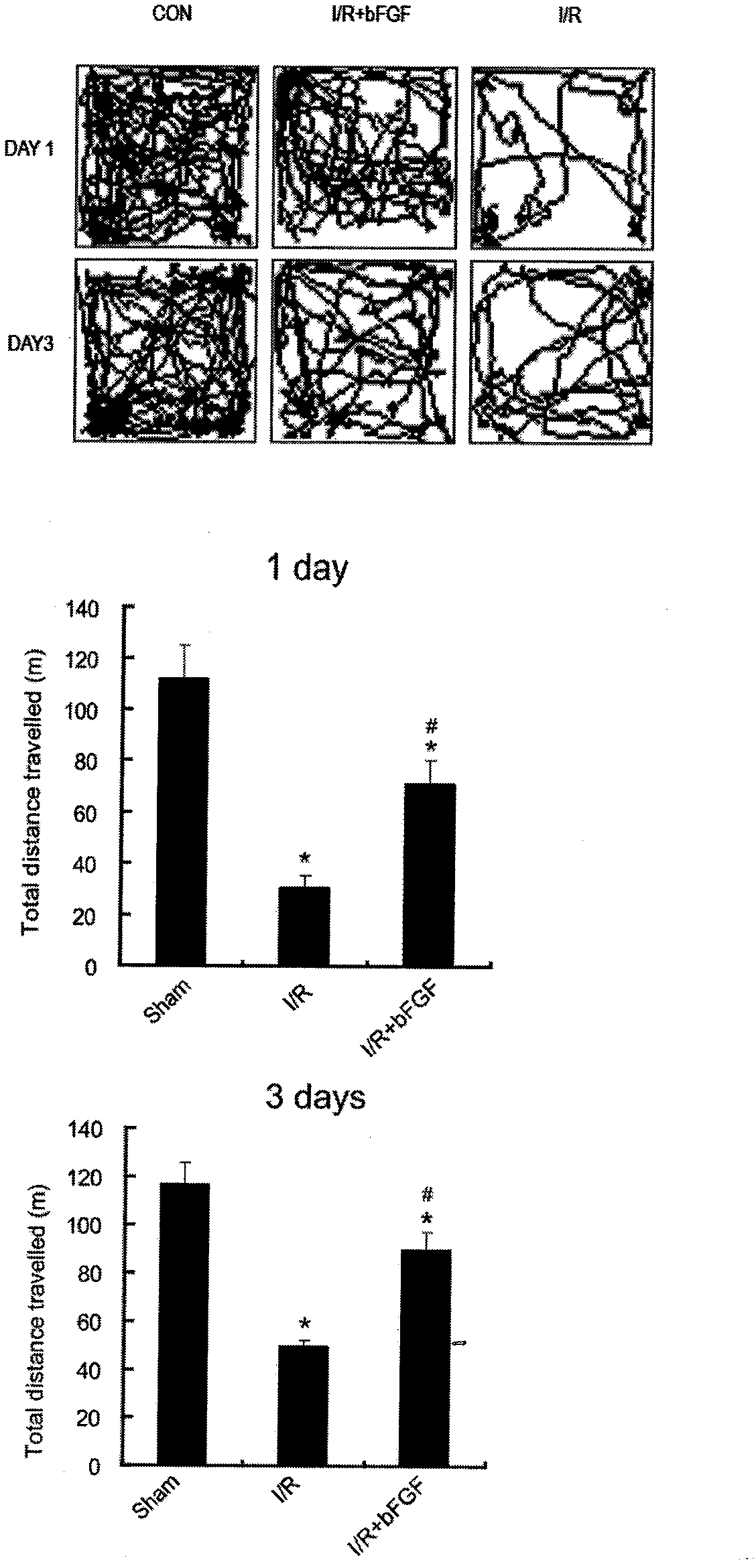 Application of bFGF (basic Fibroblast Growth Factor) to preparation of medicament for treating human ischemic stroke