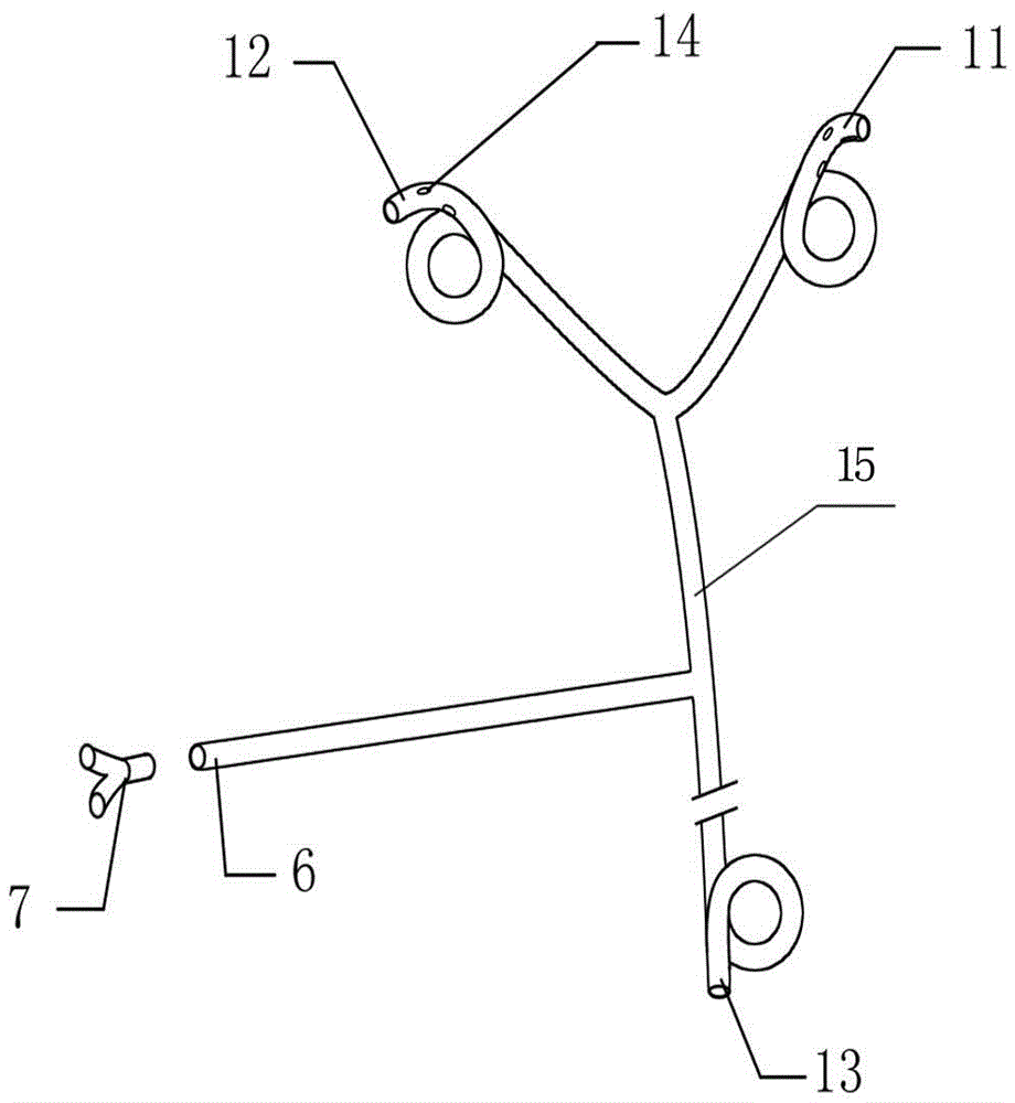 Intraperitoneal Y-T type hepatic duct-duodenum biliary tract external drainage tube