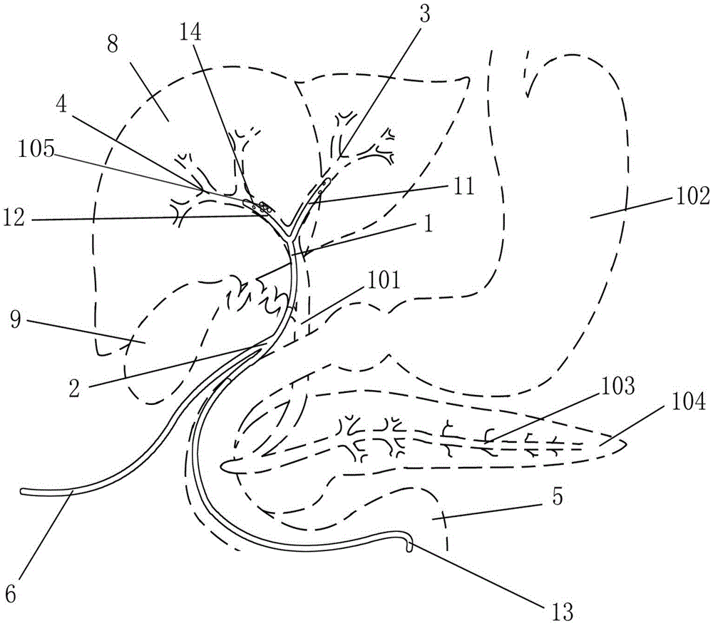 Intraperitoneal Y-T type hepatic duct-duodenum biliary tract external drainage tube