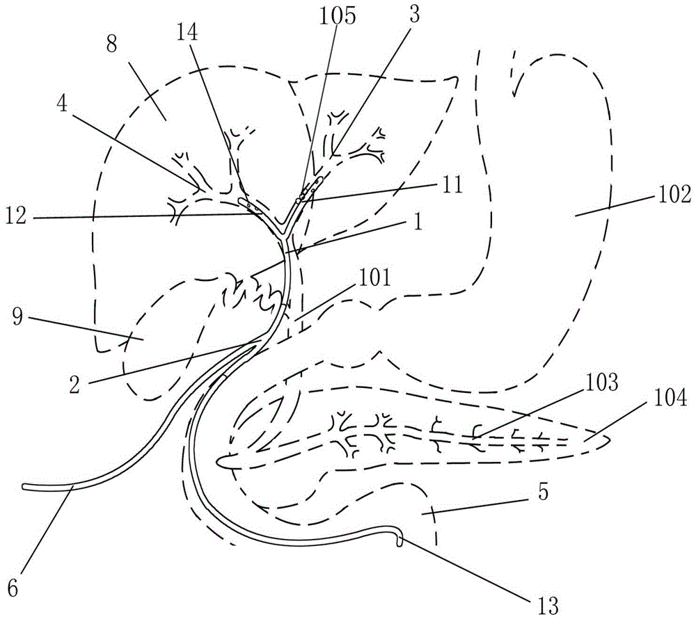 Intraperitoneal Y-T type hepatic duct-duodenum biliary tract external drainage tube