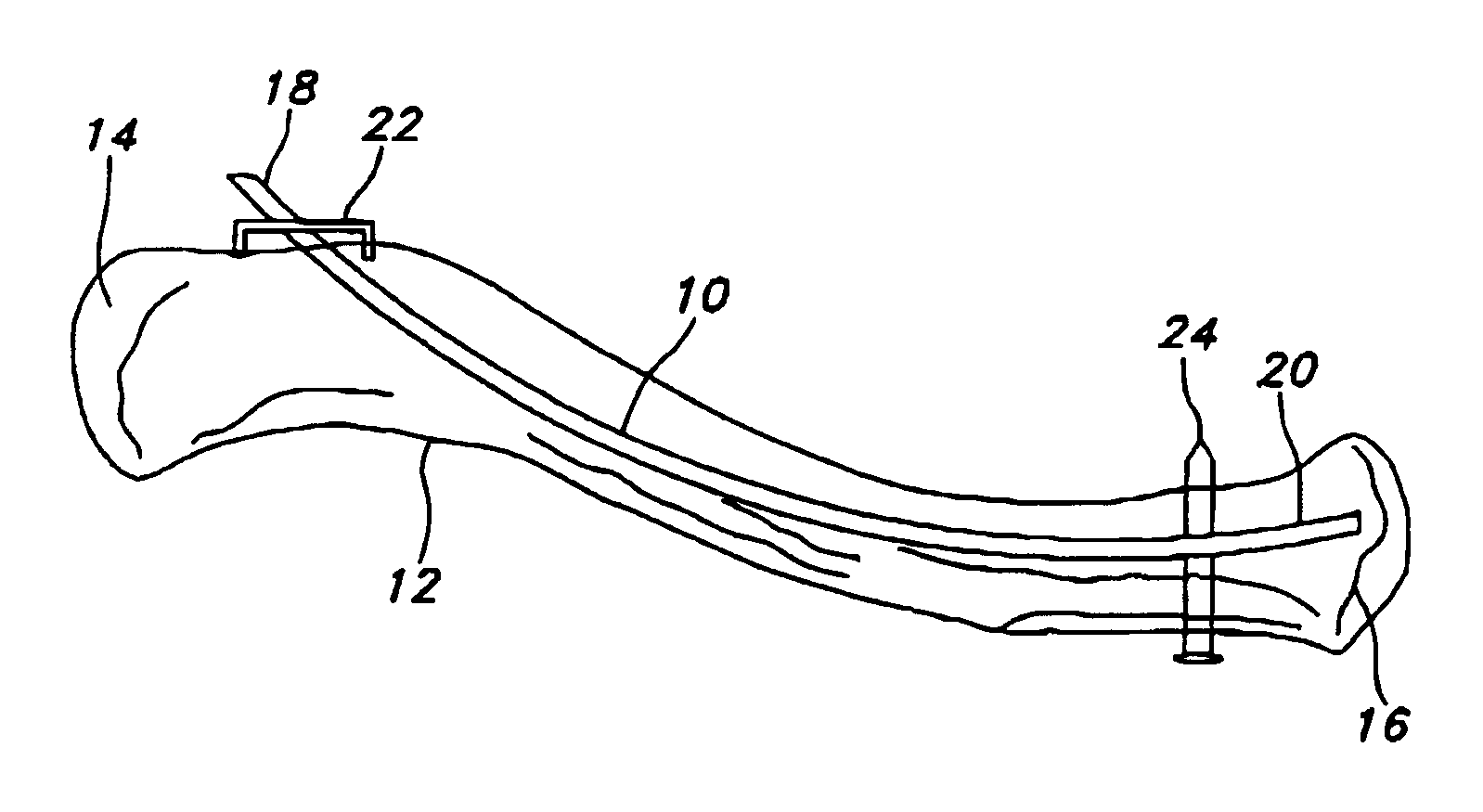 Pre-curved intramedullary clavicle nail and method of using same