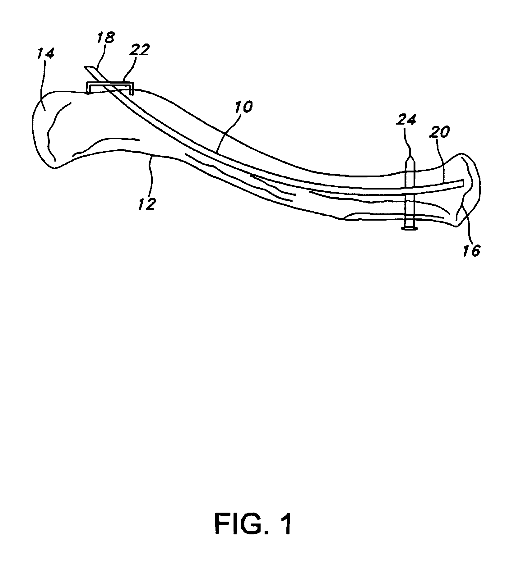 Pre-curved intramedullary clavicle nail and method of using same