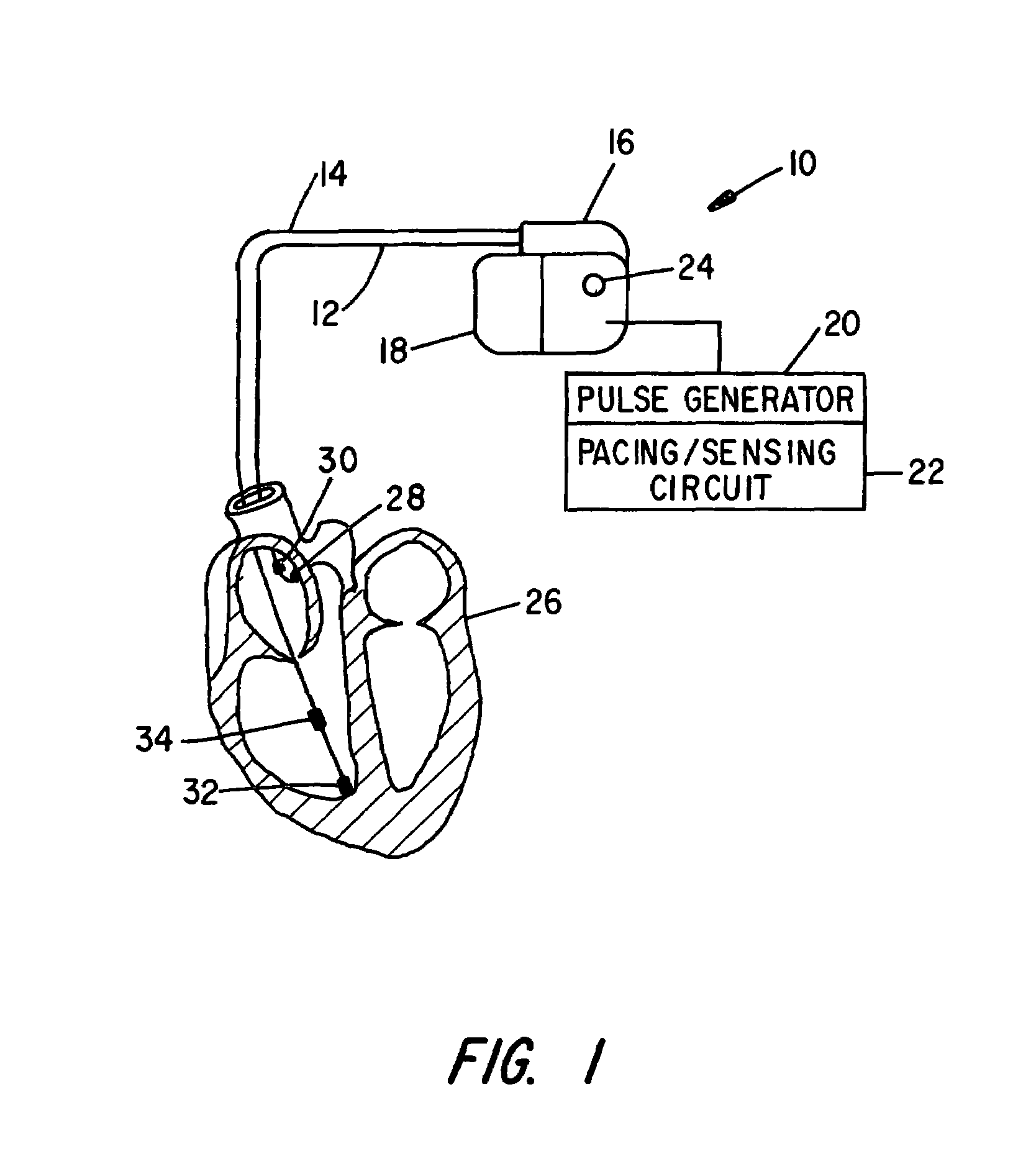 Autocapture pacing/sensing configuration