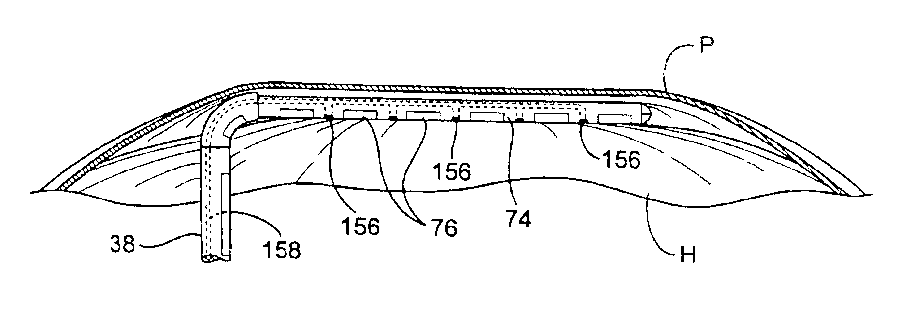 Apparatus and method for diagnosis and therapy of electrophysiological disease