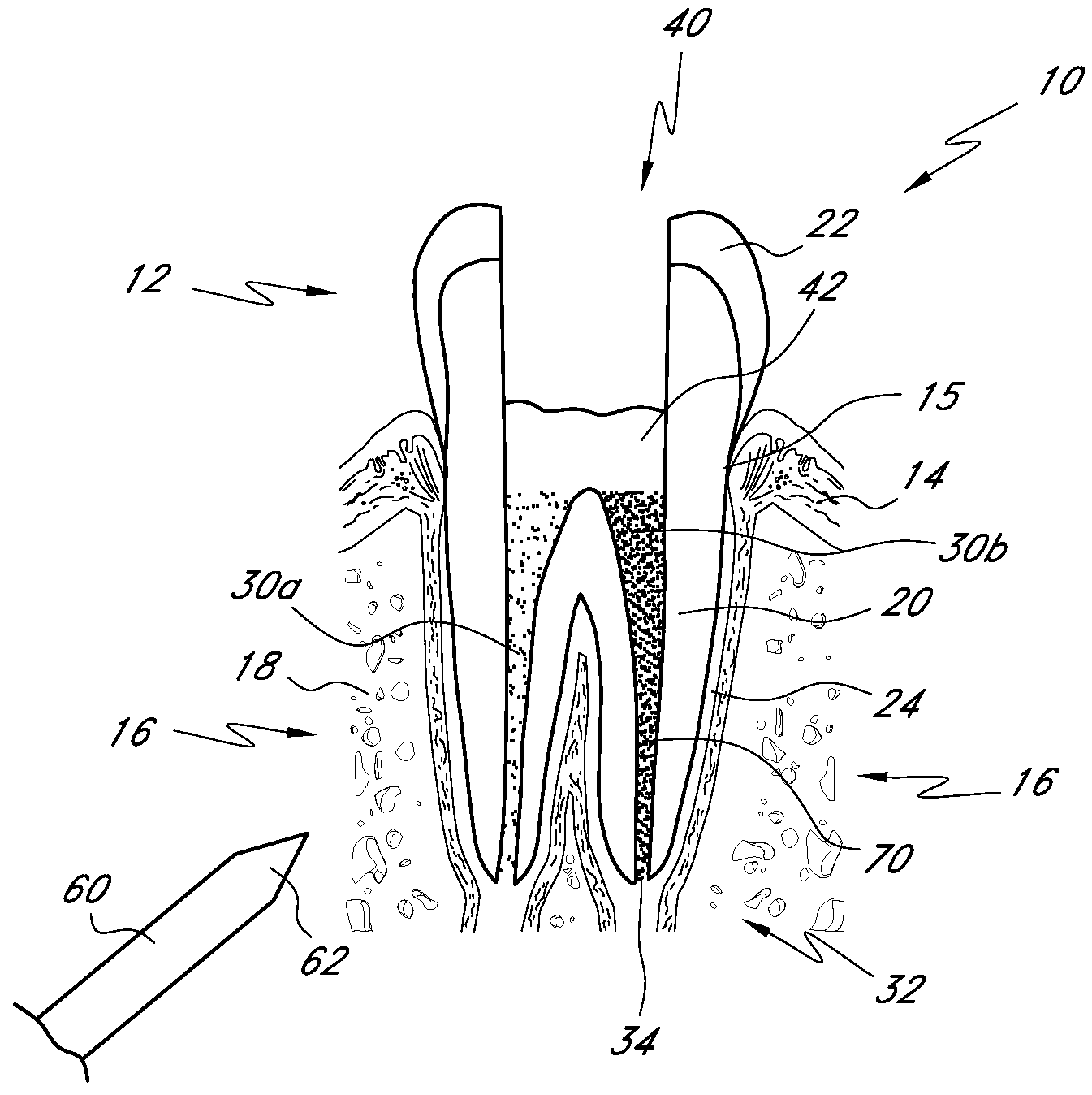 Root canal filling materials and methods