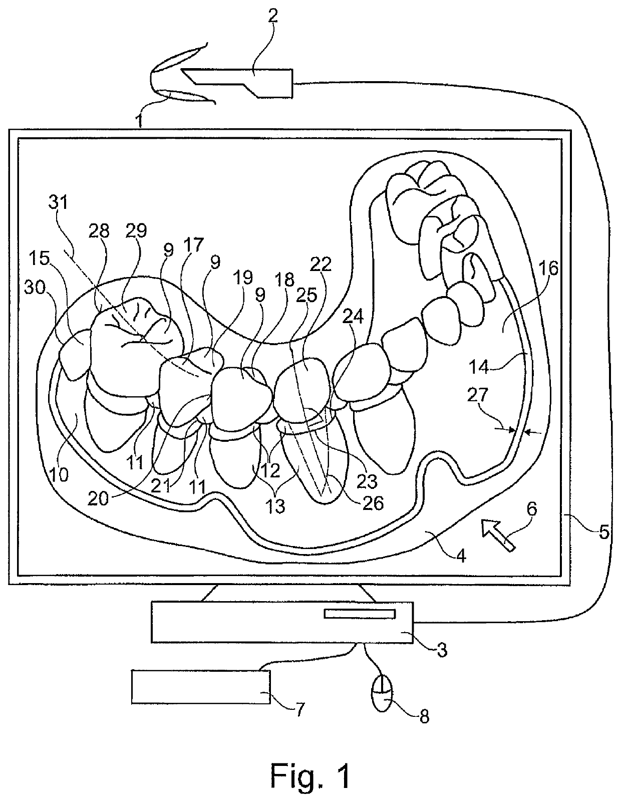 Method for the virtual secondary machining of a gingiva model