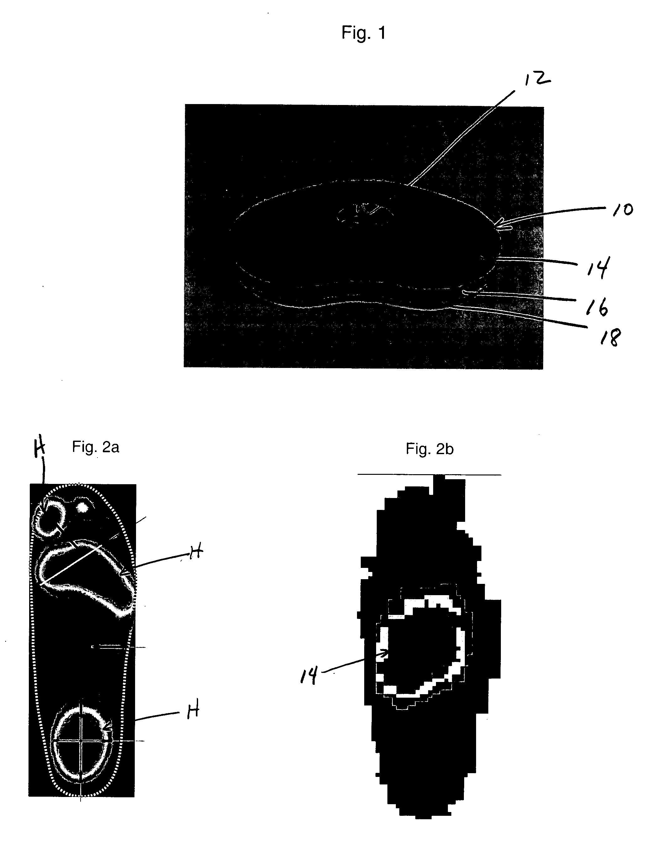 Load relieving wound dressing