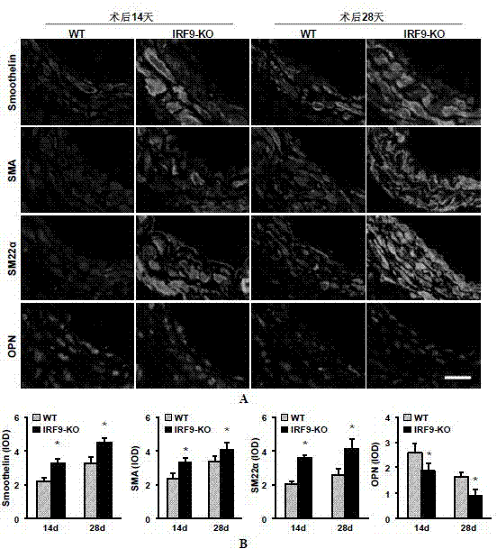 Function of IRF (Interferon Regulatory Factor) 9 in stent and carotid endarterectomy restenosis as well as application of inhibitor of IRF9