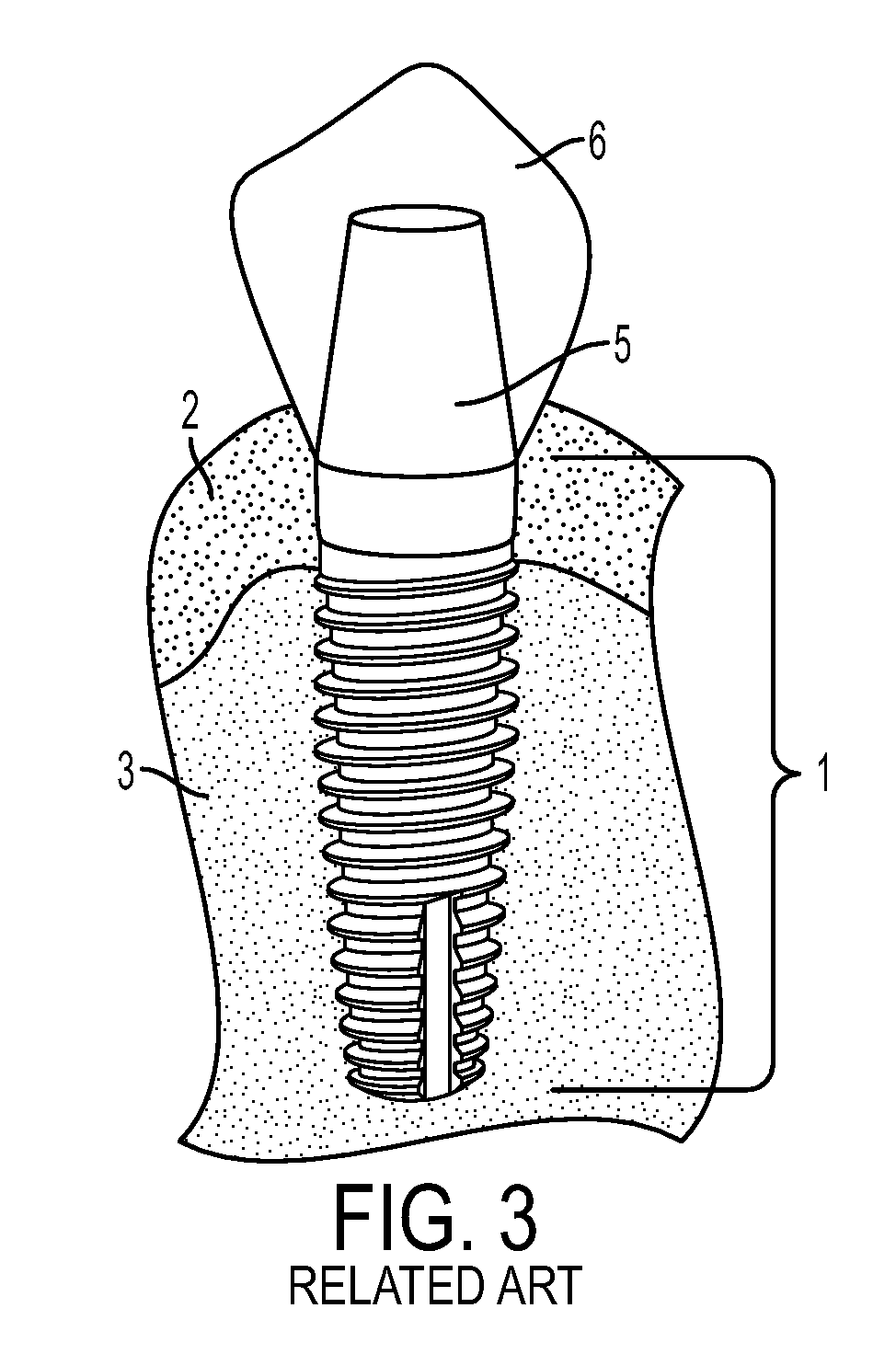 System and method for prevention and treatment of peri-implant infection