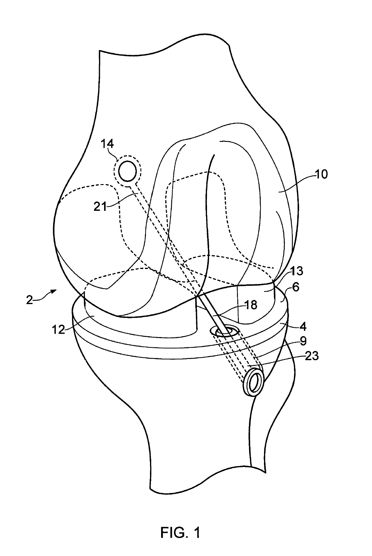 Ligament assembly