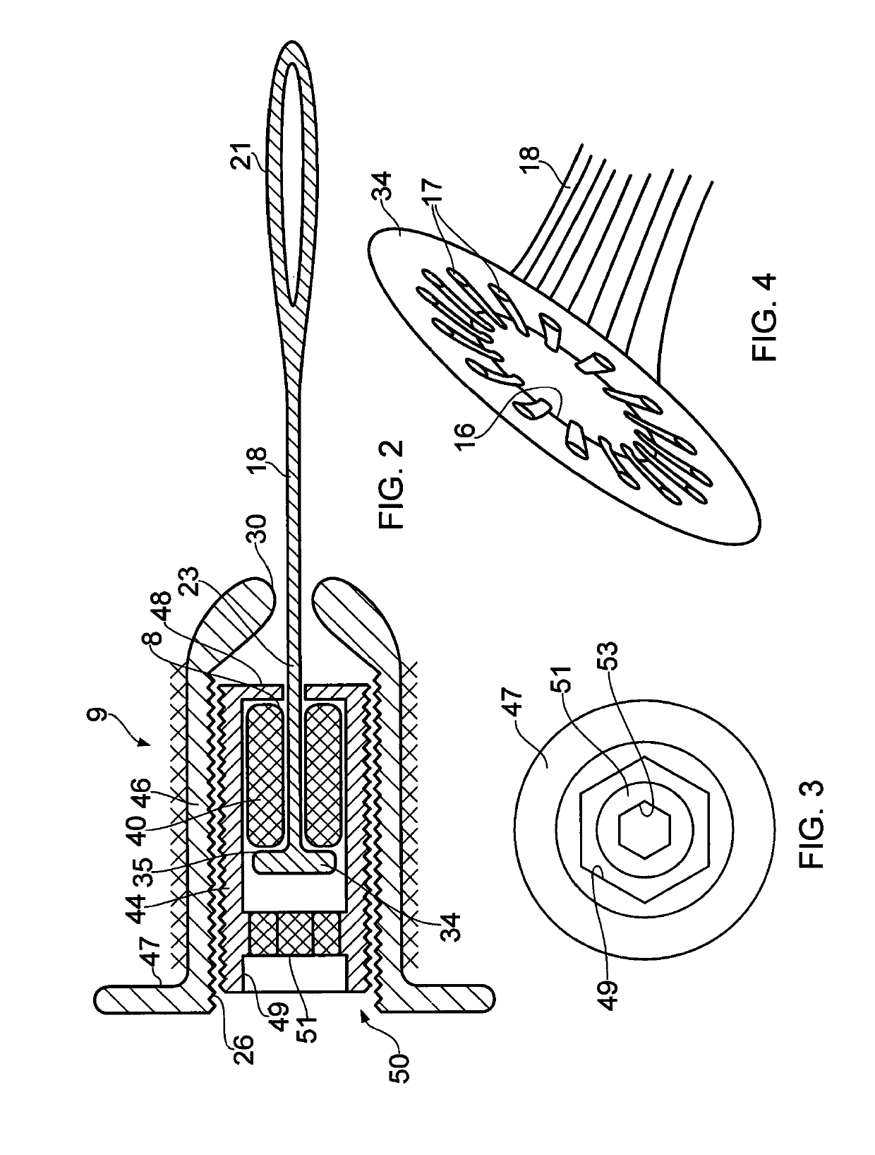 Ligament assembly