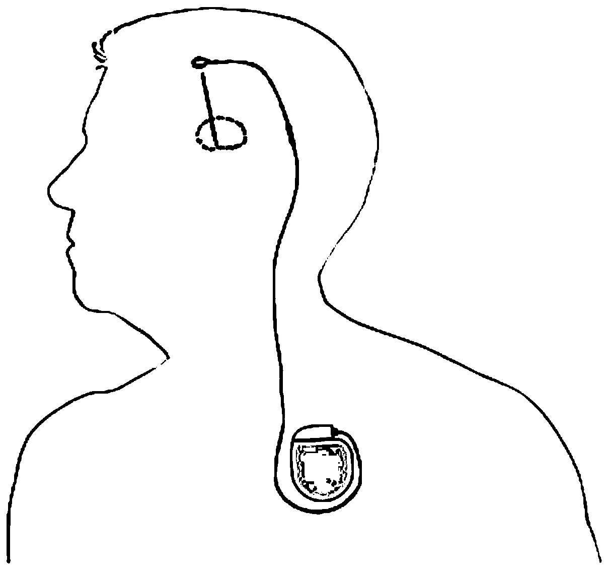 Device for stimulating habenula nucleus and/or striae medullares and/or fasciculus retroflexus in brain