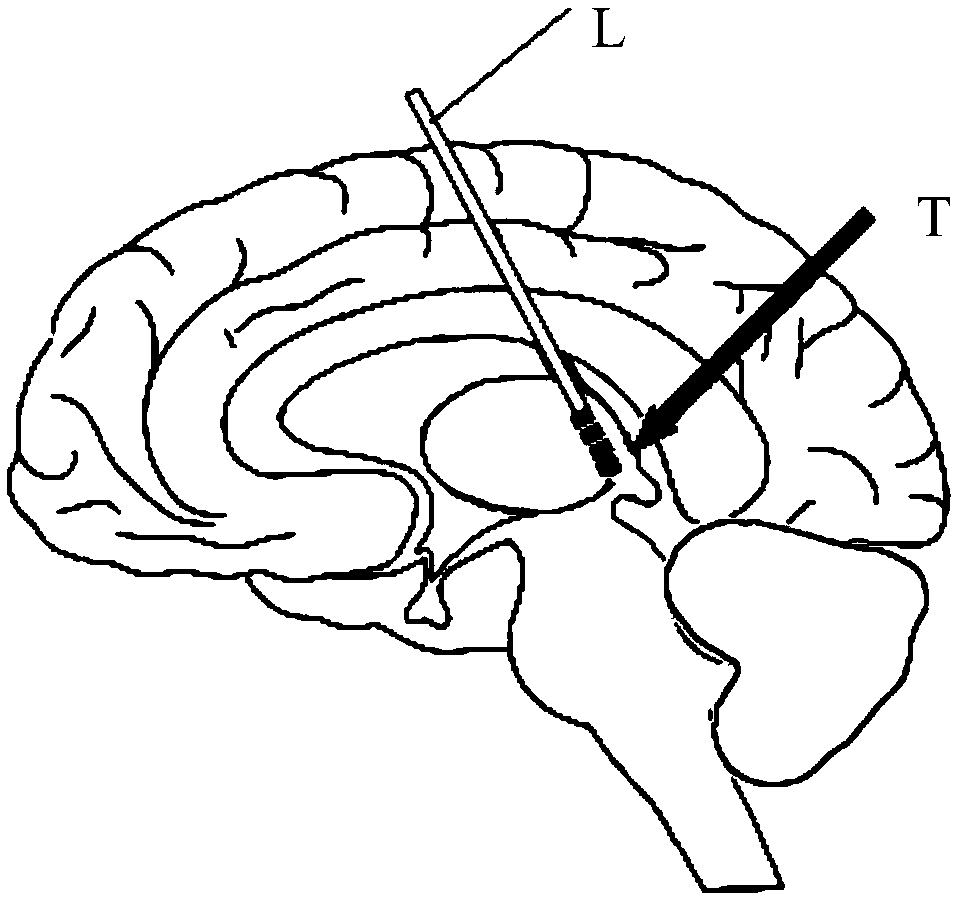 Device for stimulating habenula nucleus and/or striae medullares and/or fasciculus retroflexus in brain