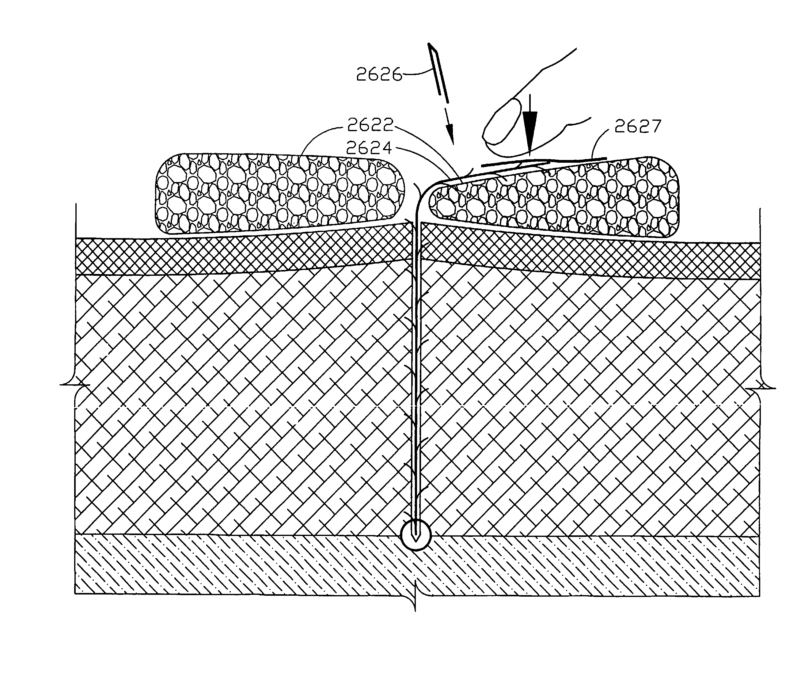 Internal and external medical closure screen systems and methods