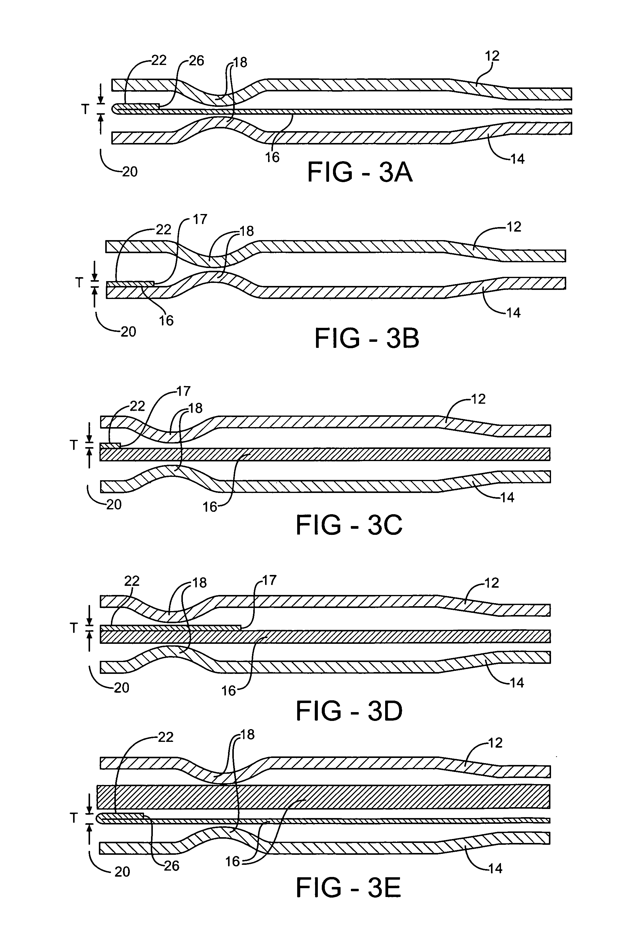 Enhanced multilayer metal gasket