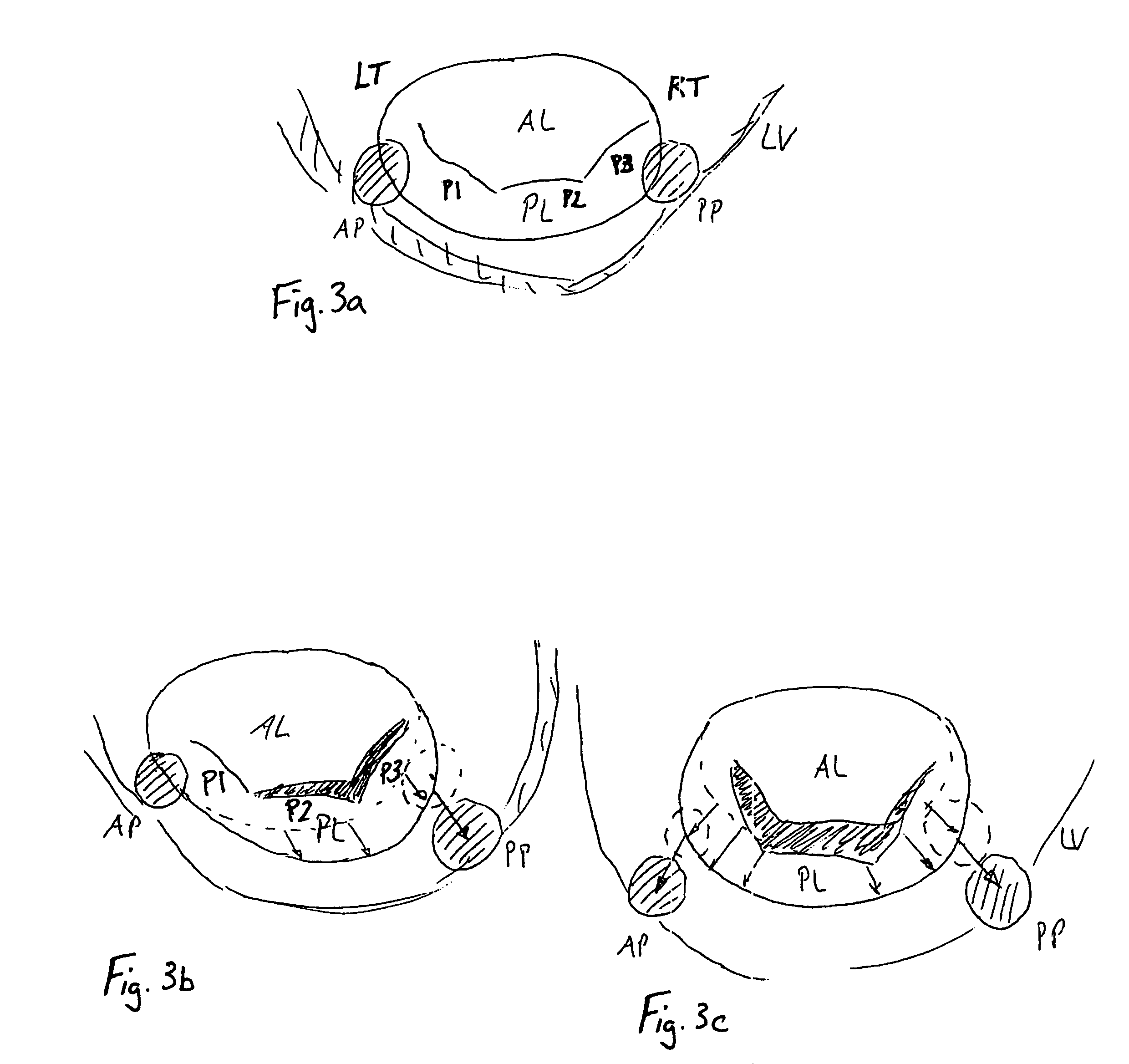 Annuloplasty ring for ischemic mitral valve insuffuciency