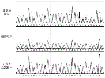 Breast cancer PIK3CA mutant gene and application thereof