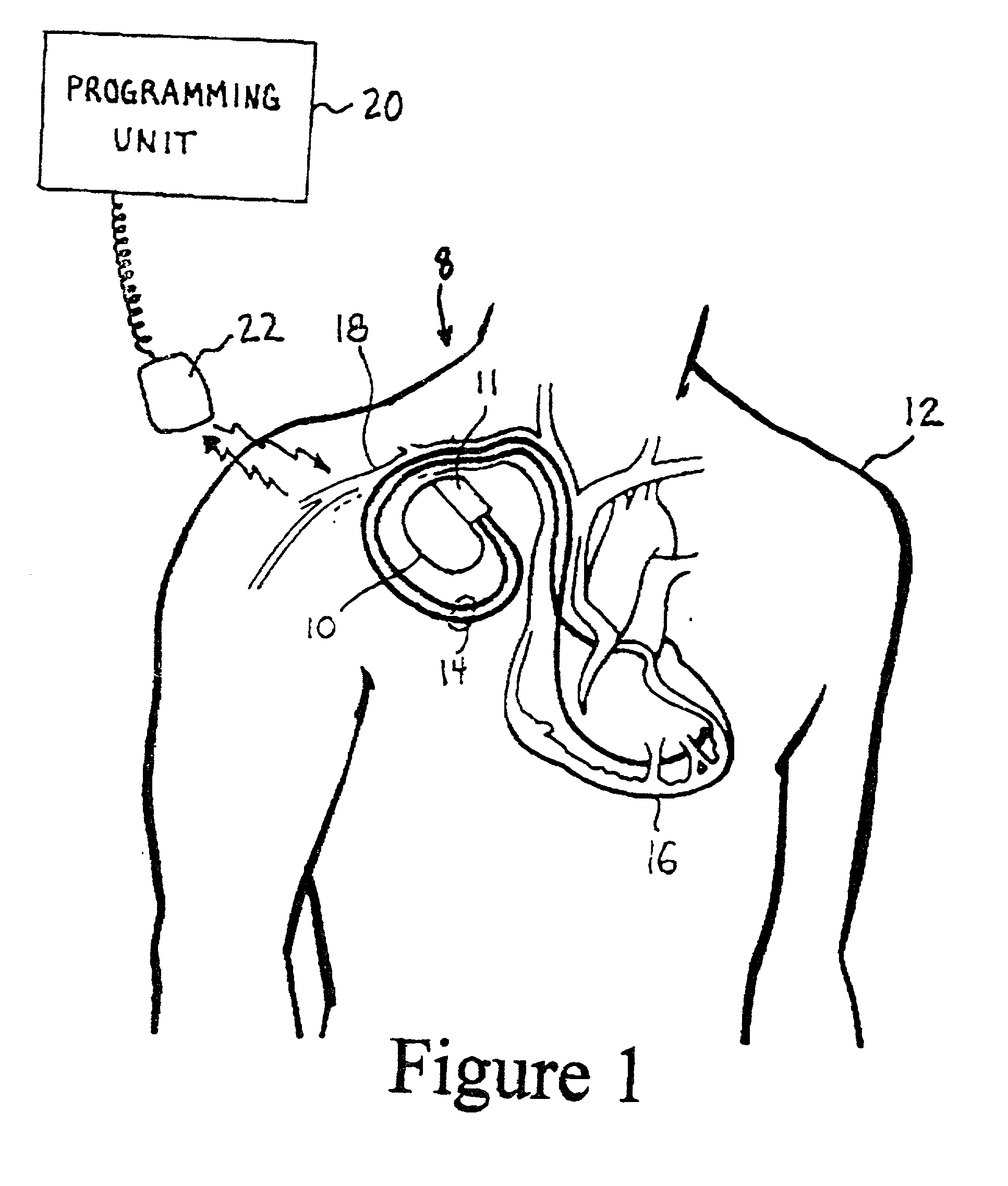 Method and apparatus for displaying information retrieved from an implanted medical device