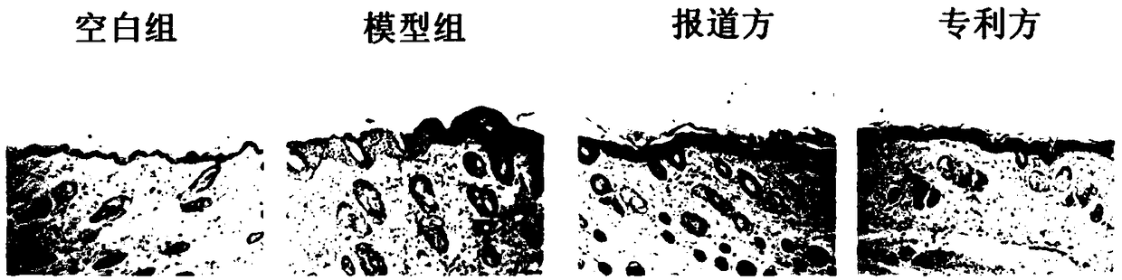 Medicine for external application for treating psoriasis