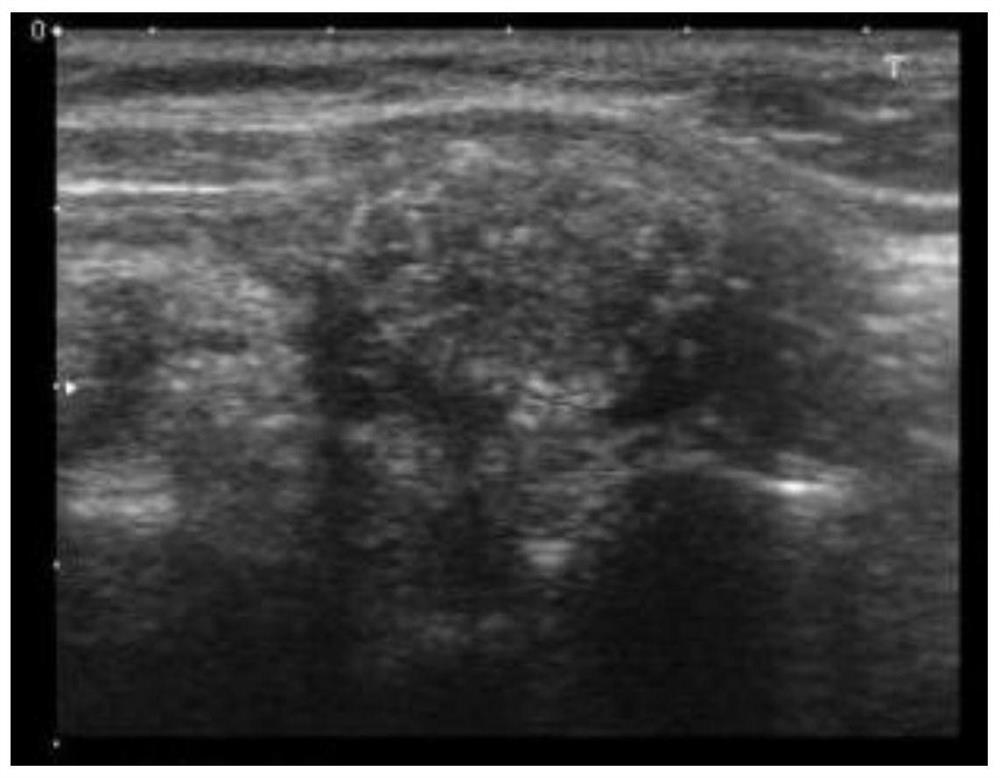 Ultrasonic image-based thyroid nodule automatic segmentation method