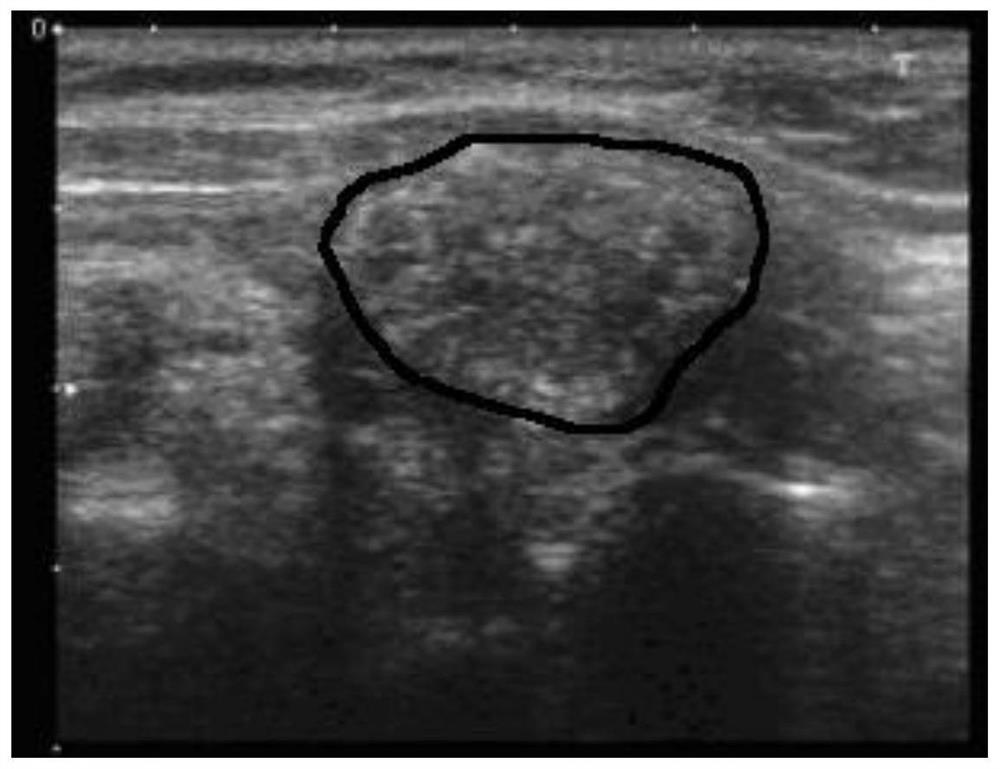 Ultrasonic image-based thyroid nodule automatic segmentation method