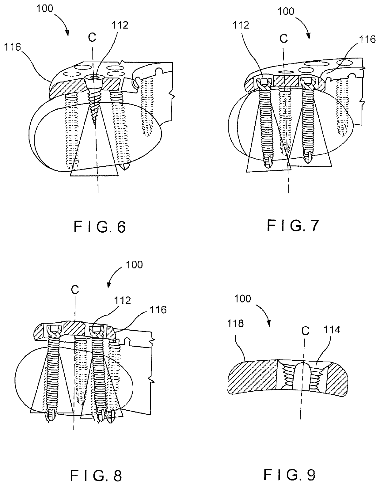 Clavicle segmental plate system