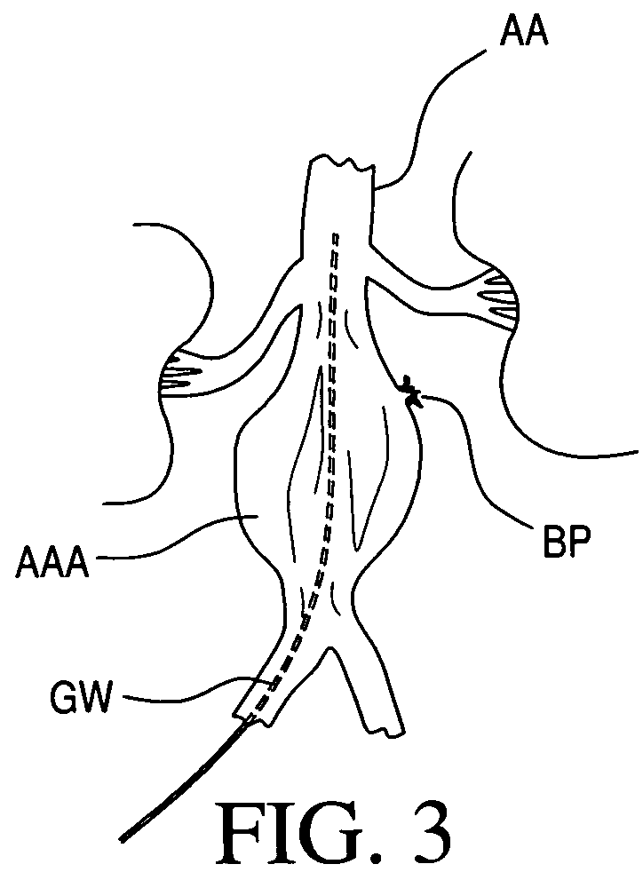 Vascular dilator for controlling blood flow in a blood vessel