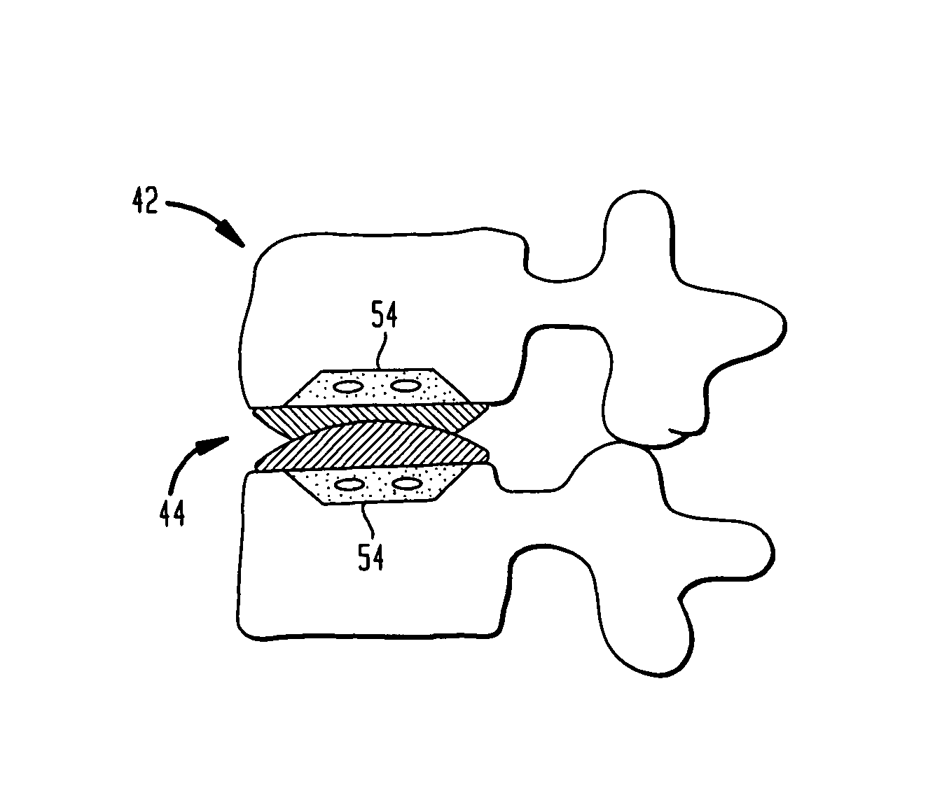 Two-component artificial disc replacements